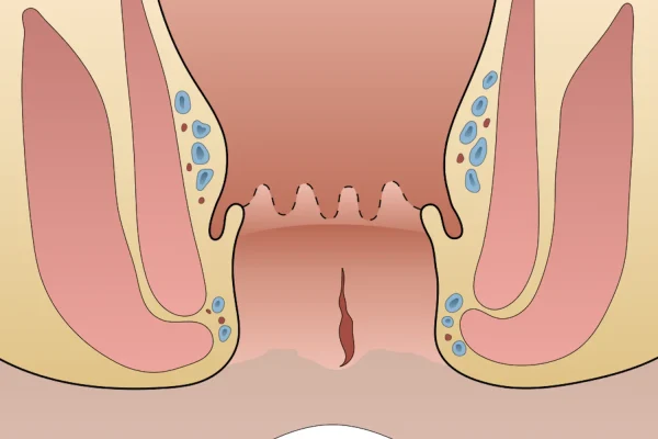Anal-Fissure-image