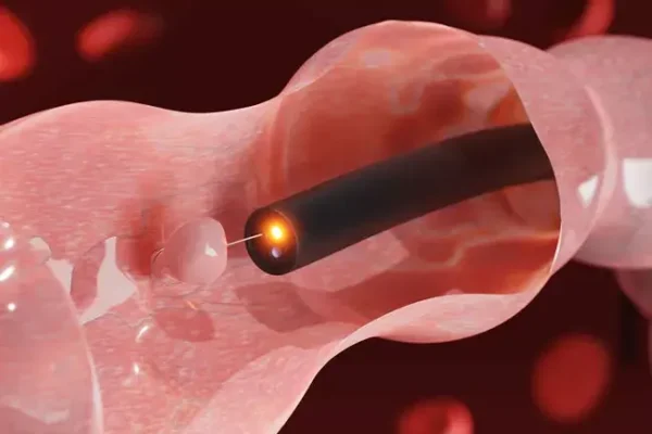 colonPolyp-1313475792-770x533-1_jpg