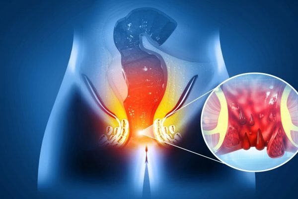 treatment-fistula
